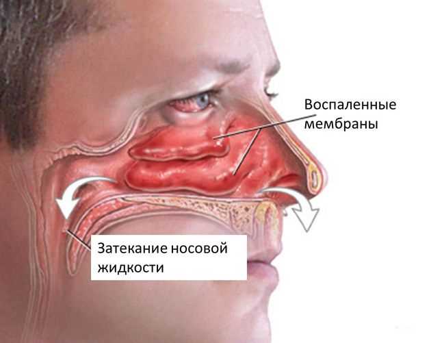 Советы по лечению аллергического гайморита