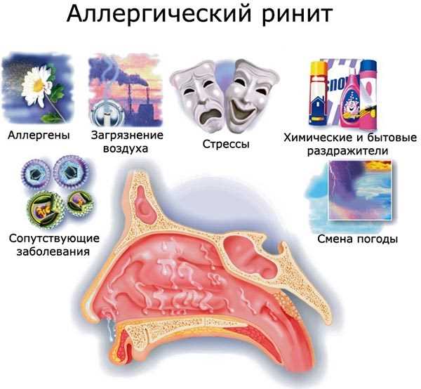 Аллергический ринит: причины и разновидности