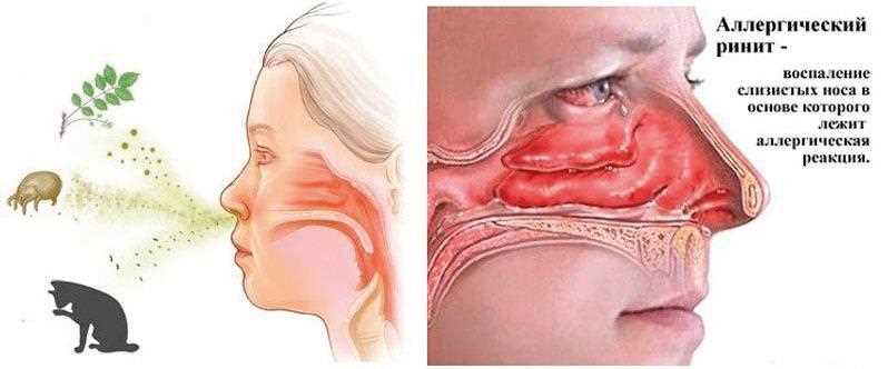 Лечение аллергического ринита