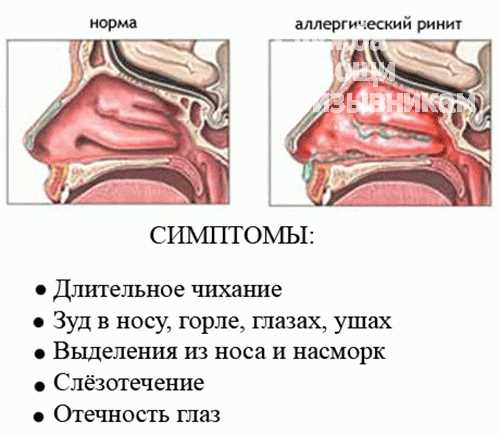 Главные причины аллергического ринита: