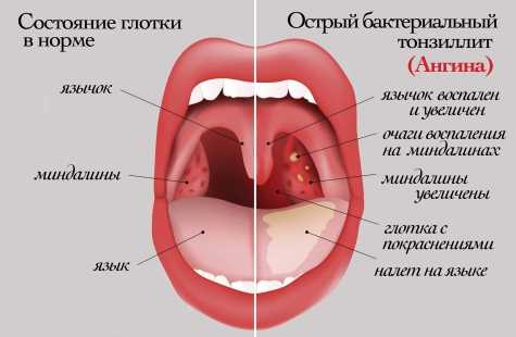 Лечение грибковой ангины