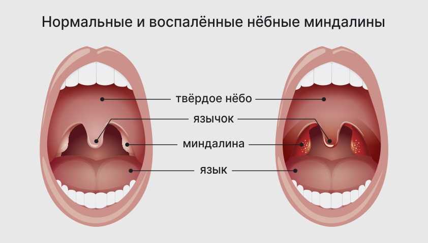 Профилактика насморка