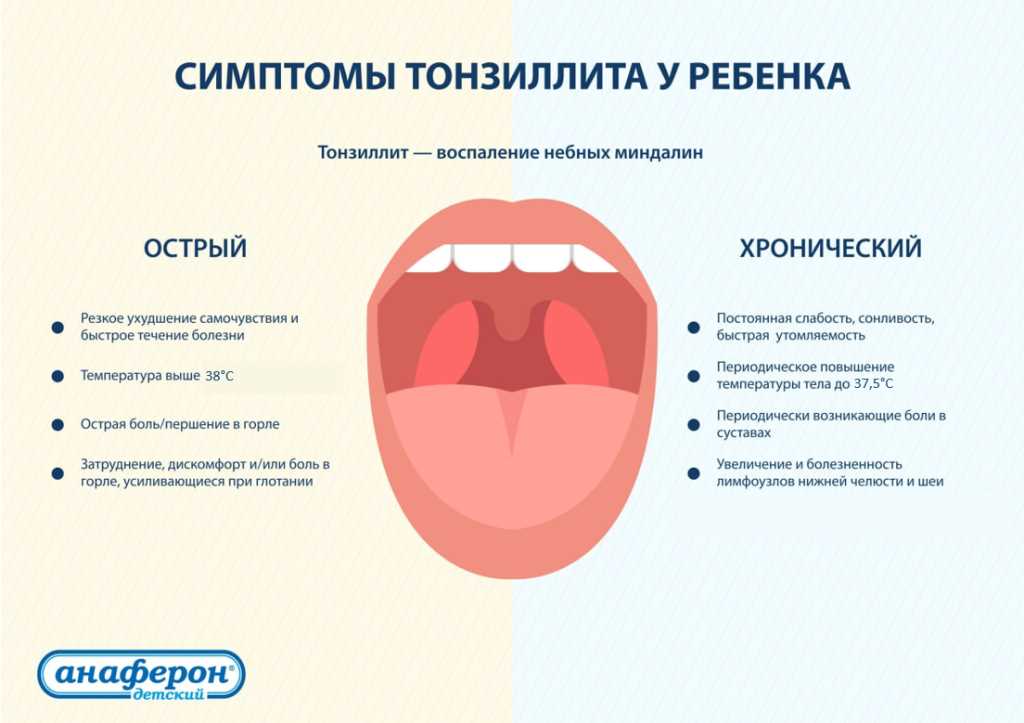 Средства лечения ангины