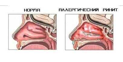 Подходы к лечению аллергического ринита в разных странах