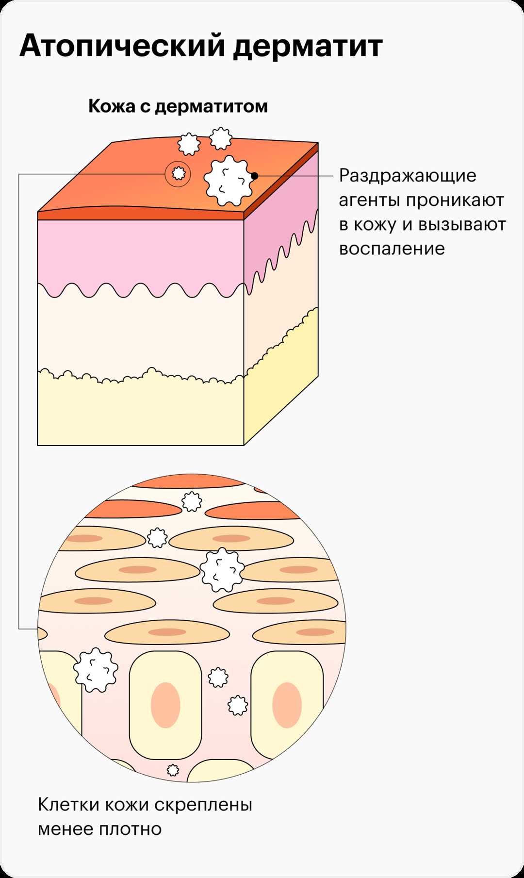 Атопический дерматит: симптомы и проявления