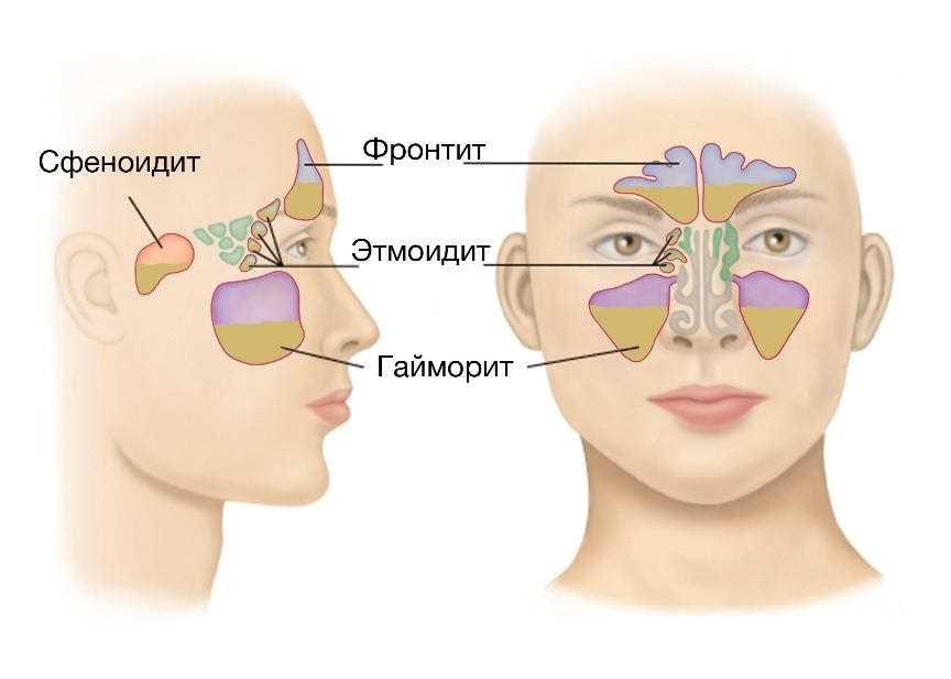 Промывание «кукушка» описание метода лечения гайморита