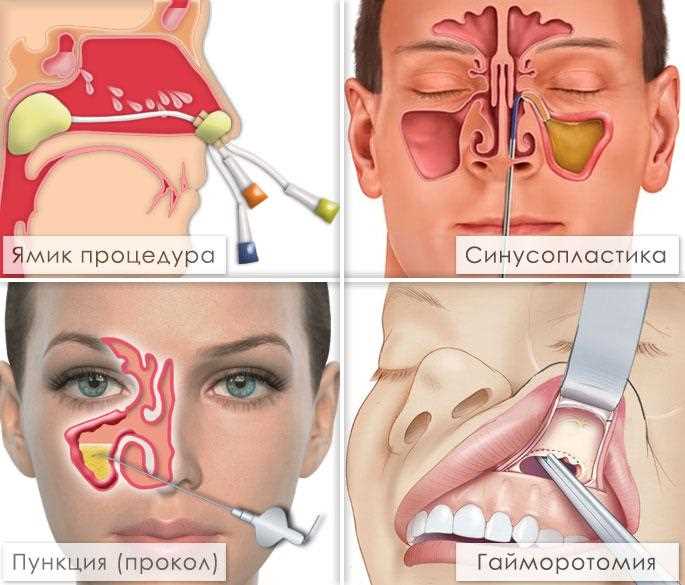 Показания к использованию турунд в лечении гайморита: