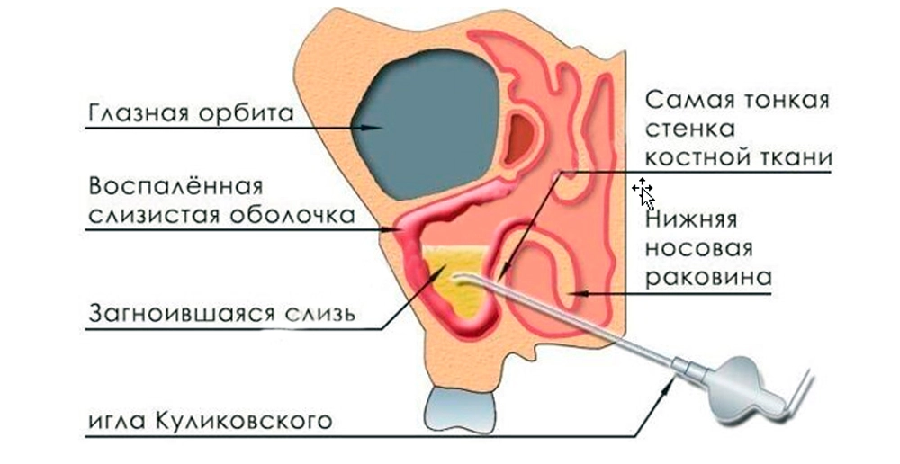 Эффективное лечение гайморита турундами основные методы и рекомендации