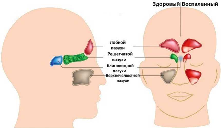 Гайморит