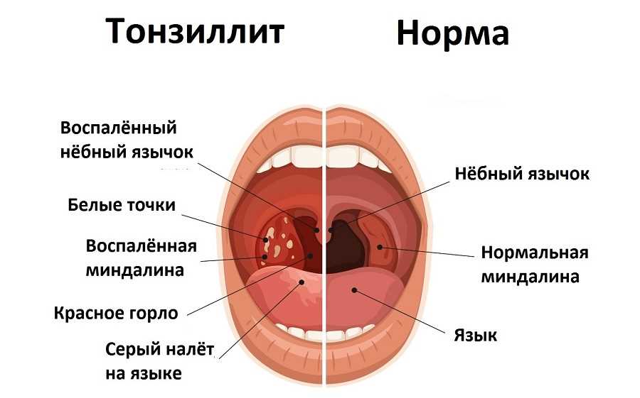 Комплексное лечение гайморита и тонзиллита: назначение и показания