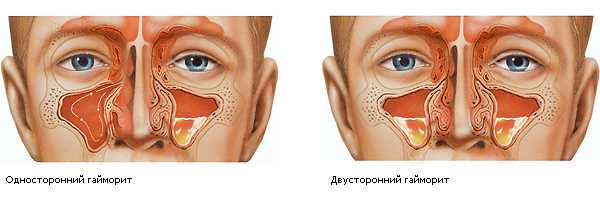 Что делать при гайморите и его связи с тонзиллитом?