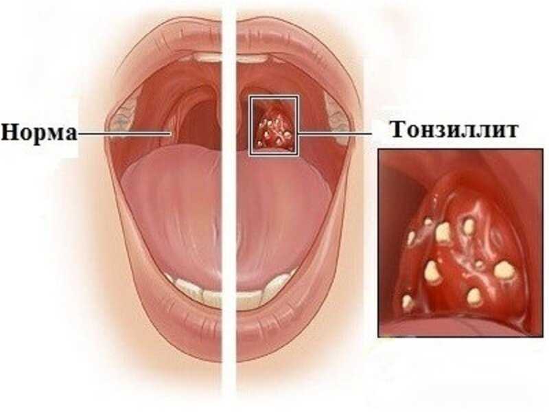 Гайморит и тонзиллит — эффективное лечение и профилактика респираторных заболеваний для здоровья и комфорта