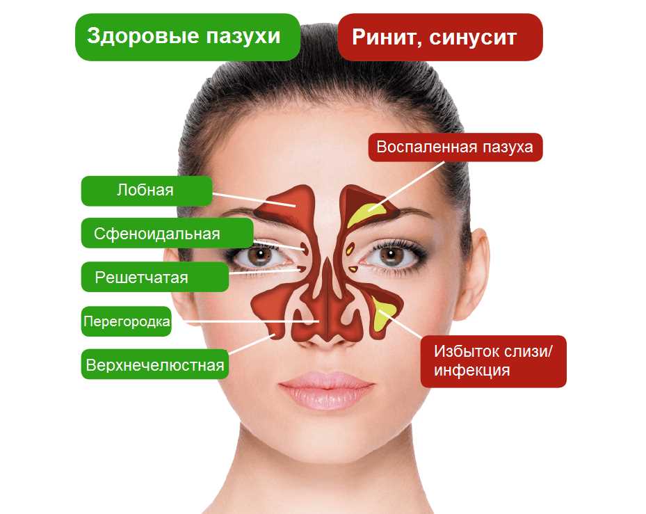 3. Развитие воспалительного процесса и структуры гайморита