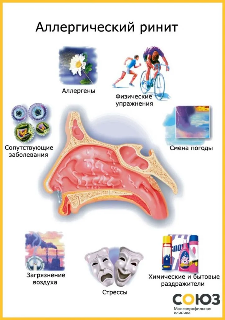 Каким врачом обратиться при появлении аллергического ринита — полезные советы и рекомендации