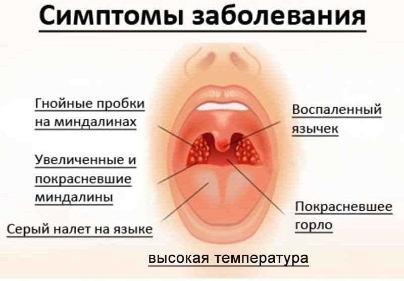 Симптомы и лечение тонзиллита