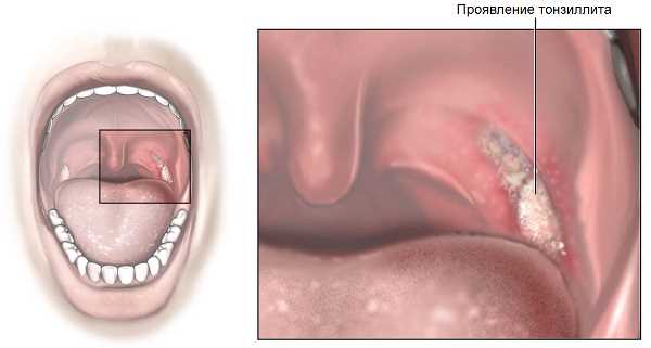 Лечение хронического ринита тонзиллита