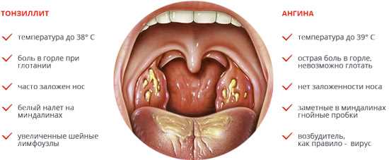 Как эффективно лечить и предотвращать хронический ринит и тонзиллит