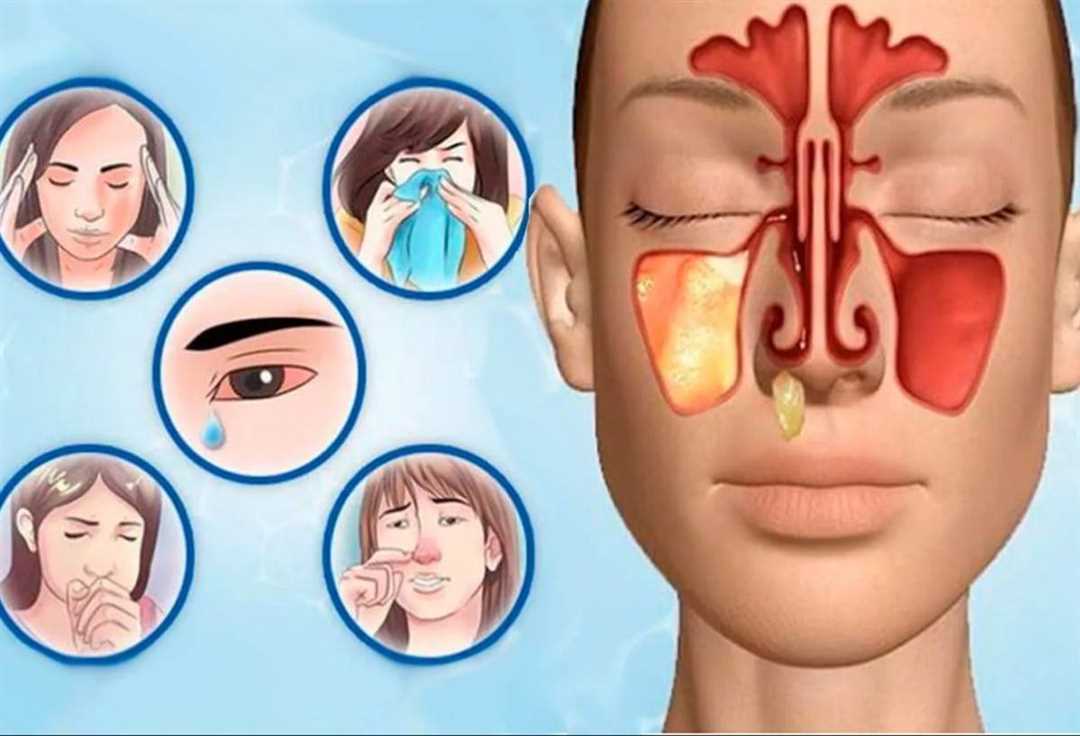 Диагностика опухоли под глазом при гайморите