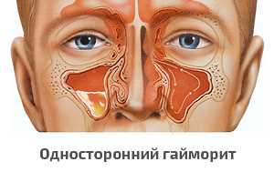 Катаральный гайморит у взрослых — симптомы, причины и методы эффективного лечения для полного выздоровления