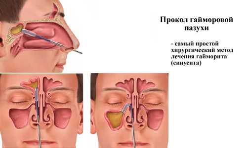 Народные методы лечения гайморита