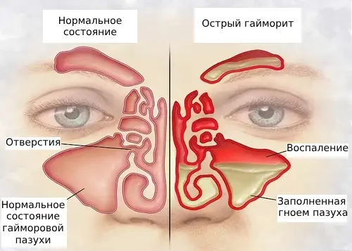 Лечение гайморита глиной