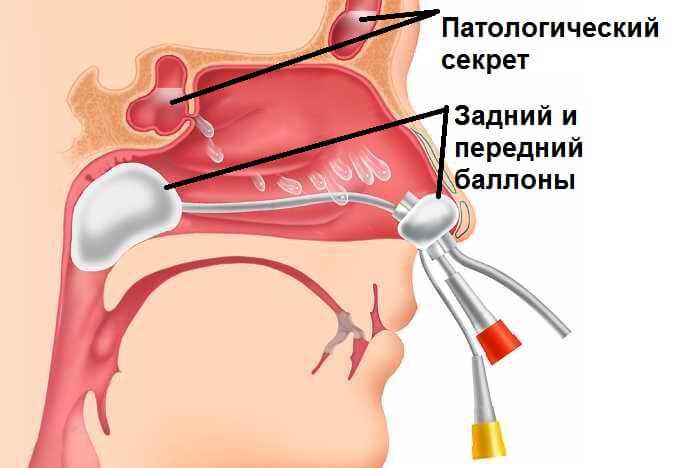 Подготовка керосина