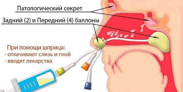 Новейший метод лечения гайморита с использованием синус катетера — надежные результаты, отсутствие противопоказаний и высокая эффективность