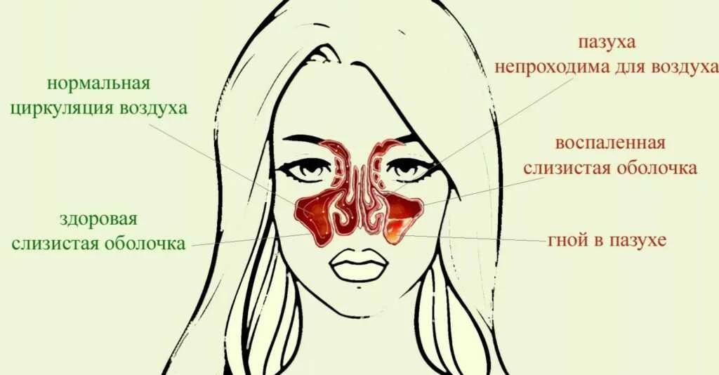 Лечение гайморита у взрослого при беременности – эффективные методы и безопасные препараты для здоровья мамы и ребенка