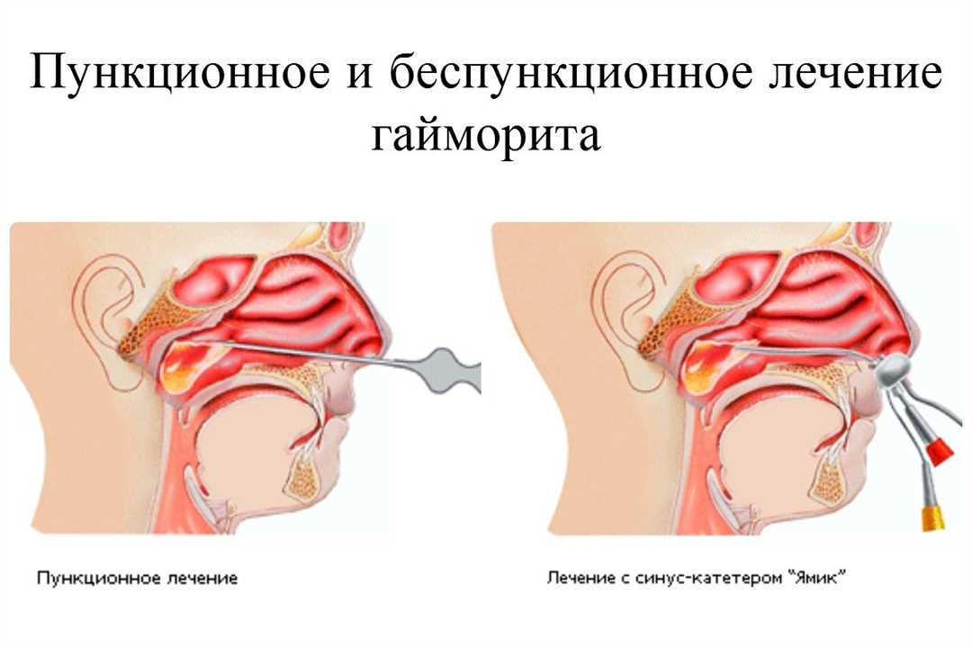 Лечение гнойного гайморита с помощью физиотерапии