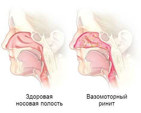 Промывание носа при аллергии