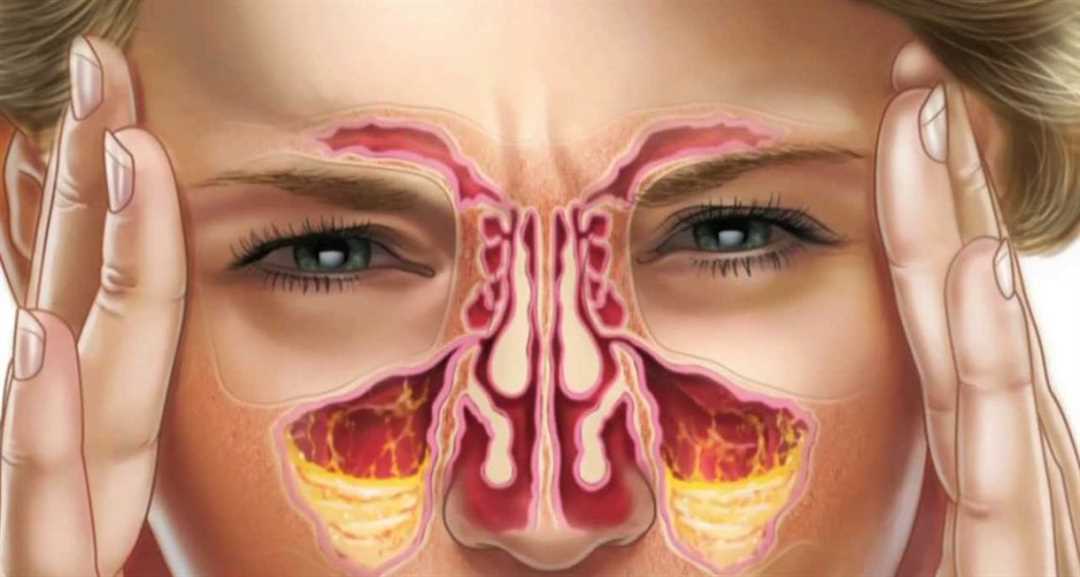 Эффективное лечение неприятного запаха в носу при насморке — проверенные методы и советы