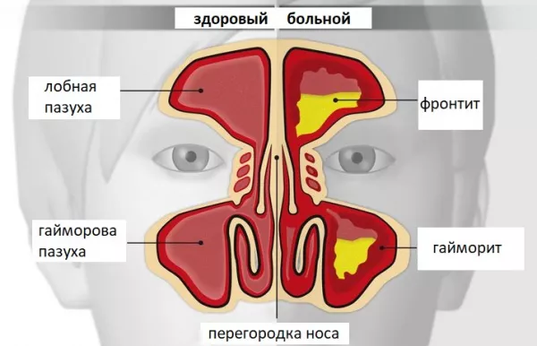 Острый двухсторонний гайморит — история болезни, симптомы и лечение