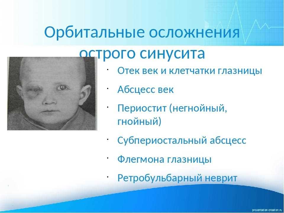 Лечение острого гайморита