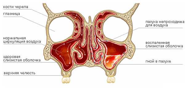 Причины острого перфоративного гайморита