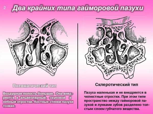 Хирургическое лечение острого перфоративного гайморита