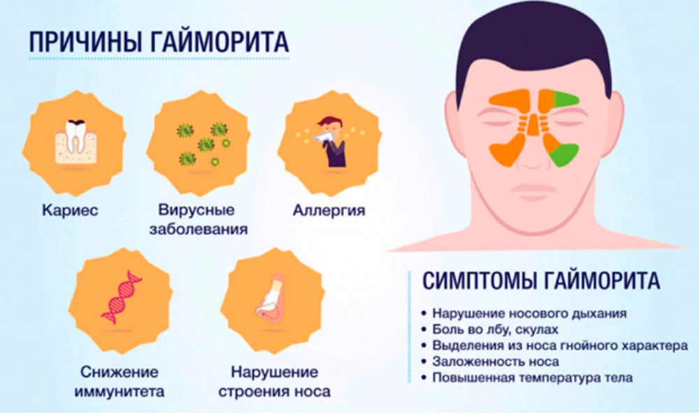 Почему возникает заложенность носа после лечения гайморита — причины и рекомендации для избежания рецидива