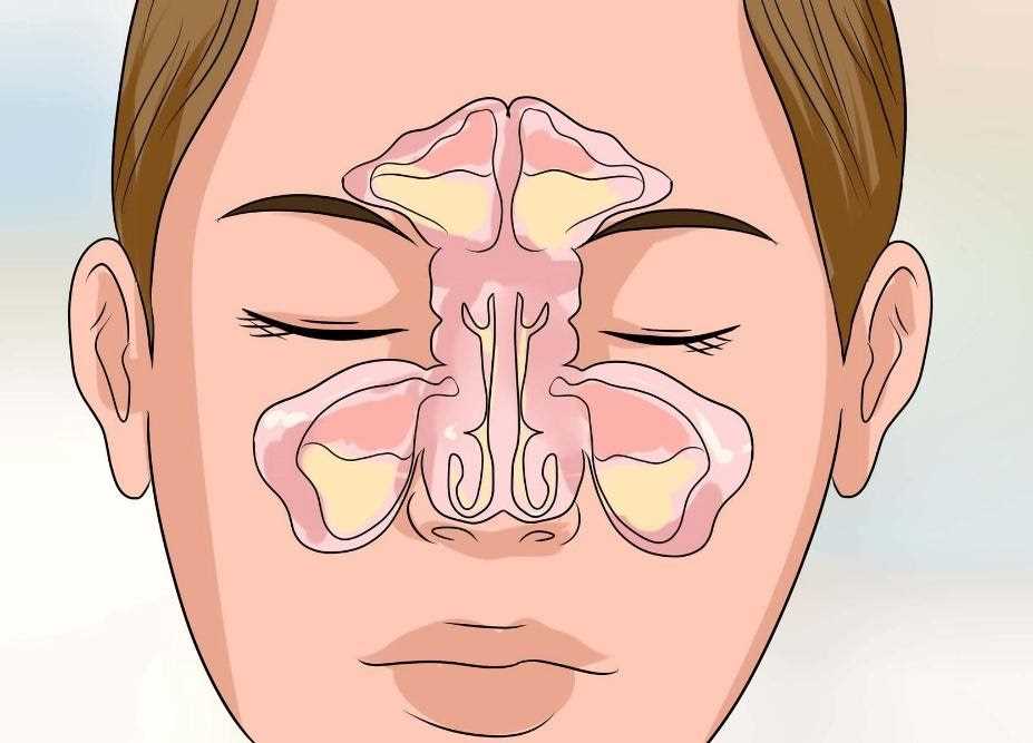 После лечения гайморита — стратегии и рекомендации по устранению головной боли