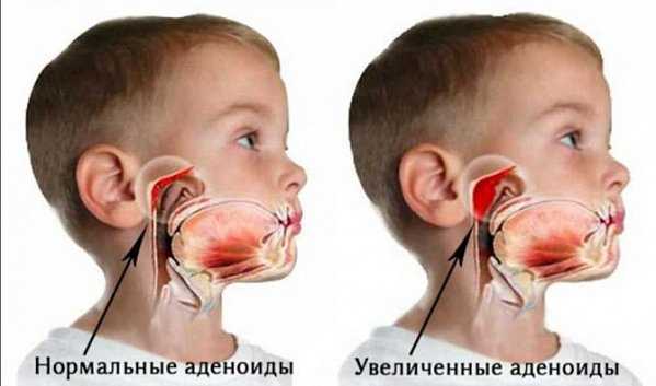 1. Солевые капли