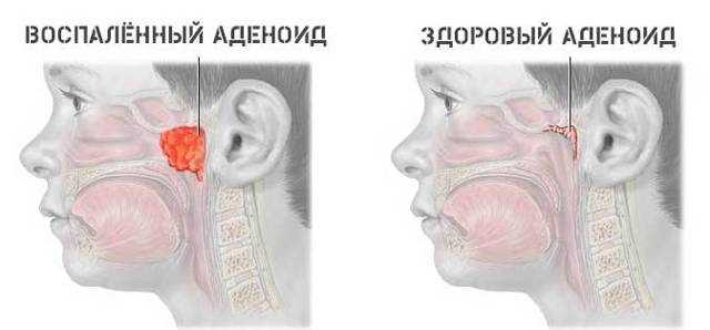 Противопоказания и ограничения