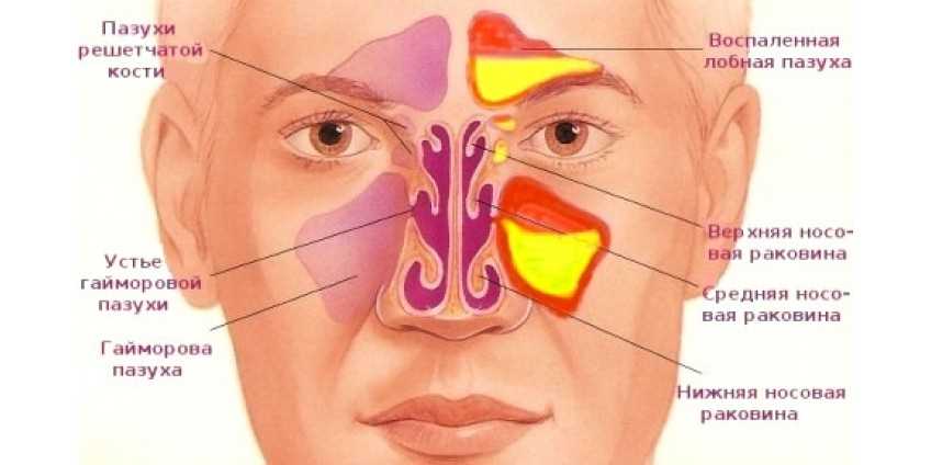  Показания и методы лечения гайморита 