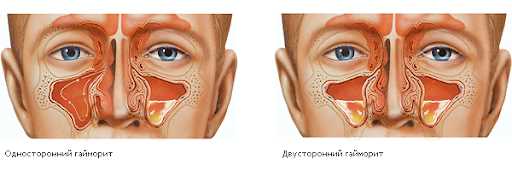 Протокол лечения гайморита у взрослых в зависимости от возраста пациентов