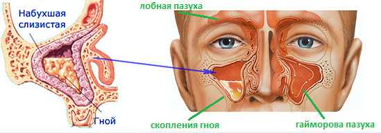 Почему гайморит может вызывать боли в ушах?