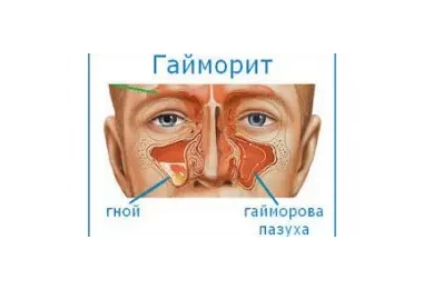 Стероидные препараты — эффективное лечение гайморита — преимущества и результаты исследований