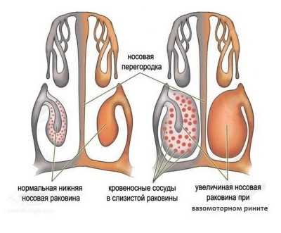 Классификация вазомоторного ринита