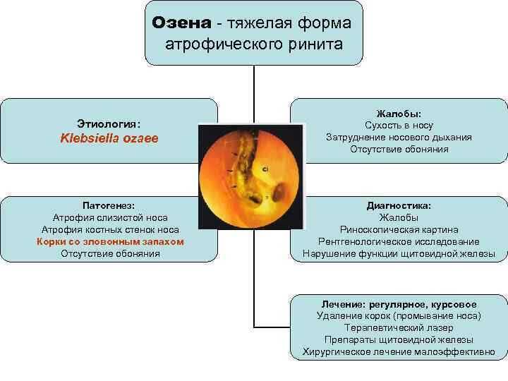 Хронический атрофический ринит озена – определение, симптомы, причины и способы лечения данного неприятного заболевания носовых пазух