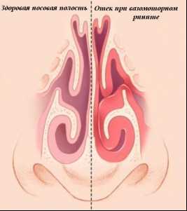 Хронический ринит и искривление перегородки носа — причины, симптомы и эффективные методы лечения