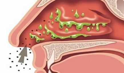 Способы диагностики хронического ринита КТ