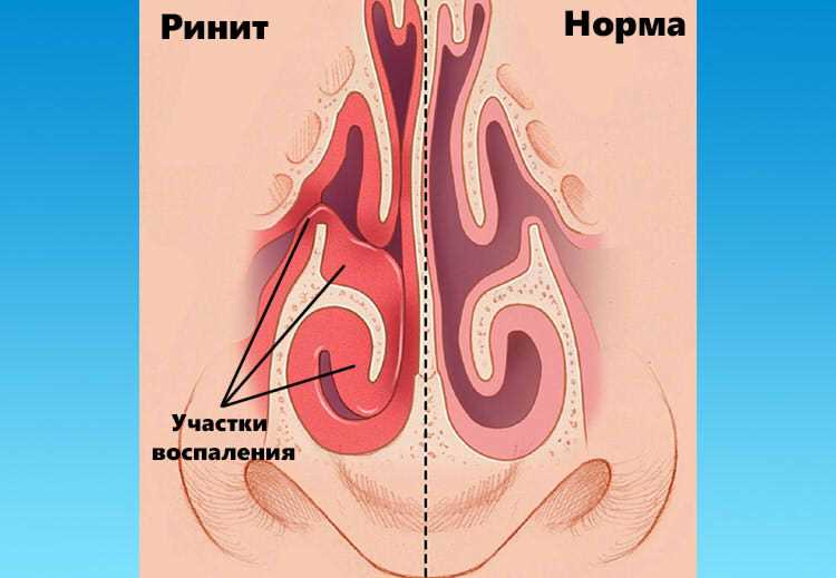 Симптомы хронического ринита